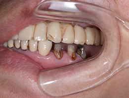 歯質削除量の増大